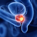 לפי מחקר, צריכת תוסף אומגה 3 עלול להגביר סיכון לסרטן הערמונית